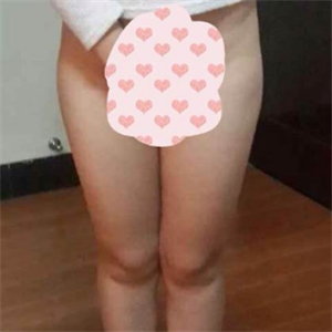 看看我大腿吸脂的恢復果圖片吧，是東方和諧王自謙做的